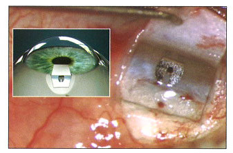 EL GLAUCOMA